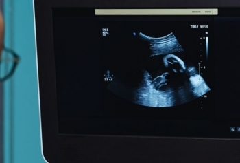 Doktorlara Karın Ağrısıyla Gitti 35 Yaşında "Taş Bebek" Fetüsü Çıktı