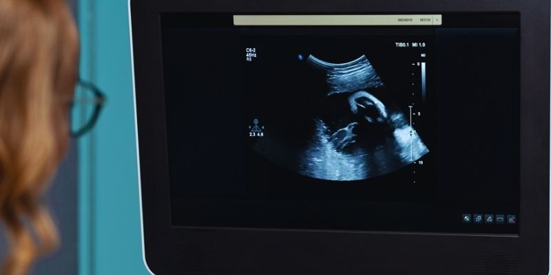 Doktorlara Karın Ağrısıyla Gitti 35 Yaşında "Taş Bebek" Fetüsü Çıktı